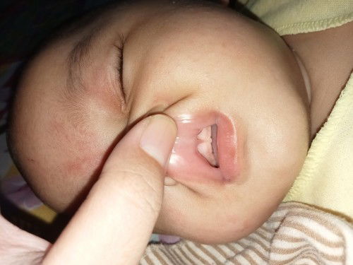 Lip tie anak usia 4 bulan