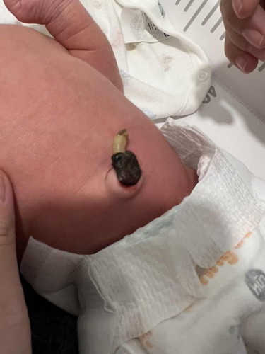 สายสะดือยังไม่หลุด และมีเลือดซึมตลอด