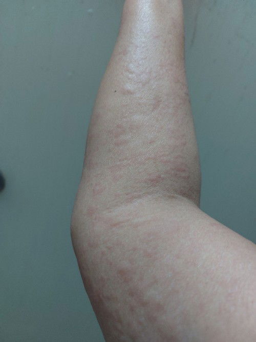 เป็นลมพิษตอนท้อง