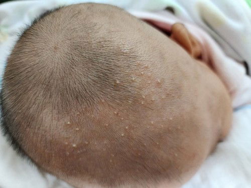 ศรีษะลูกขึ้นผื่นแบบนี้คืออะไรคะ