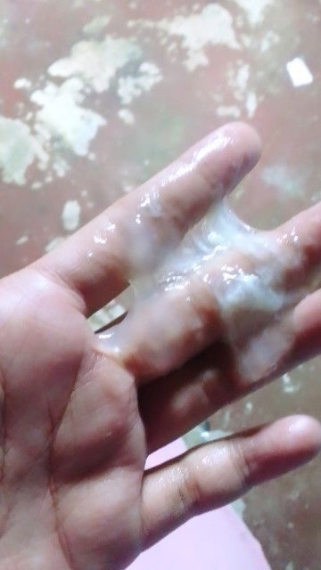 ทั้งปั้นท้องแข็งบ่ายมากแล้วมีมูกใสแบบในภาพออกเยอะด้วยค่ะ รวมทั้งมีปวดท้องน้อย แบบนี้คือยังไงค่ะ