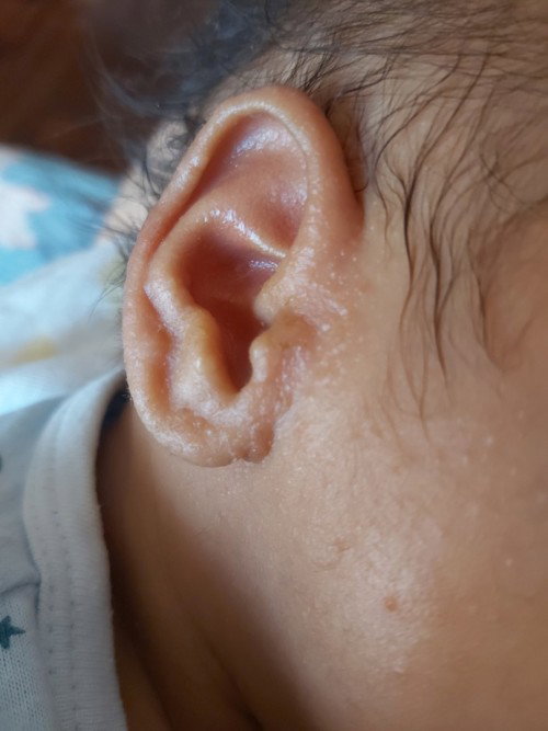 Bakit po kaya ganito ang ears ni LO? Normal lang po ba ito?
