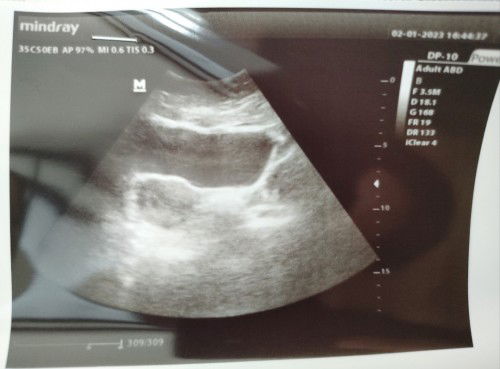 Usia USG dan HPHT berbeda