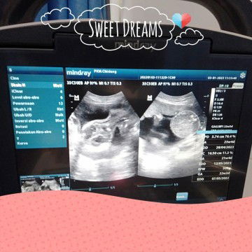 Seputar Kehamilan (Hasil USG)