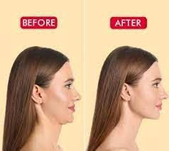 Find Out how to get rid of double chin overnight