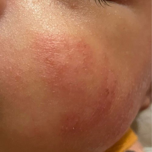 Ruam merah di pipi