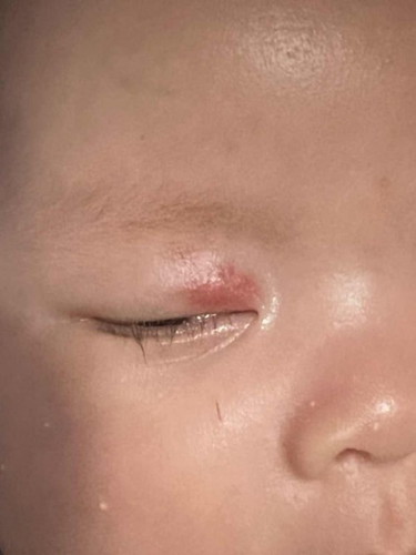 Red Birthmark