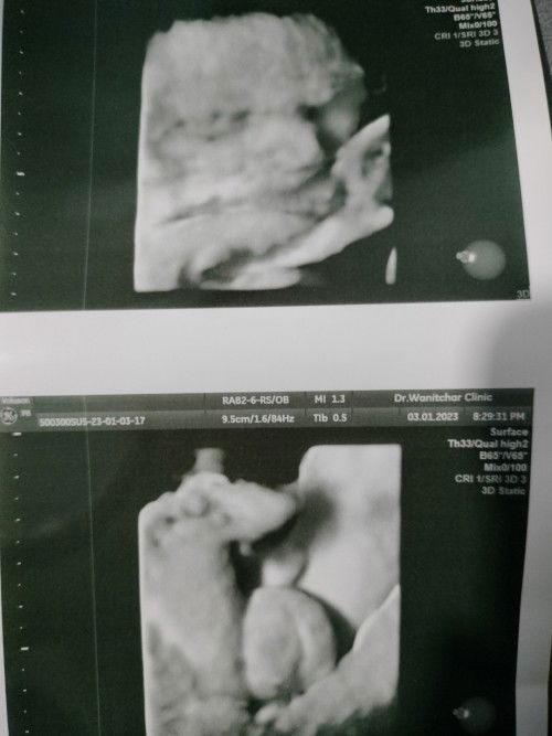 ท้องได้31 W ท้องแข็งบ่อยมาก