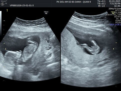 Các mom ơi cho e hỏi xíu,e thai đã 13,5 tuần,e đi siêu âm thì bs bảo bầu bé trai,nhưng sợ siêu âm ở