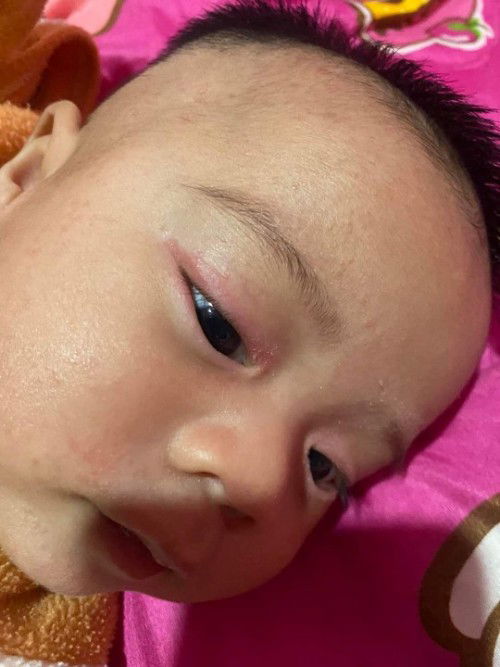 ขอบตาลูกแดง