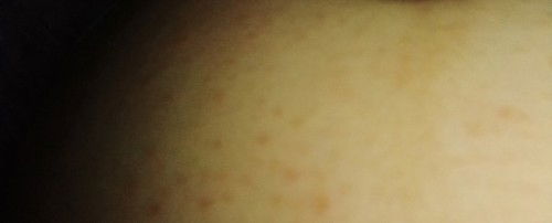 hi sissy sino na nka try na nag ka rashes sa tyan dahil sa kamot?