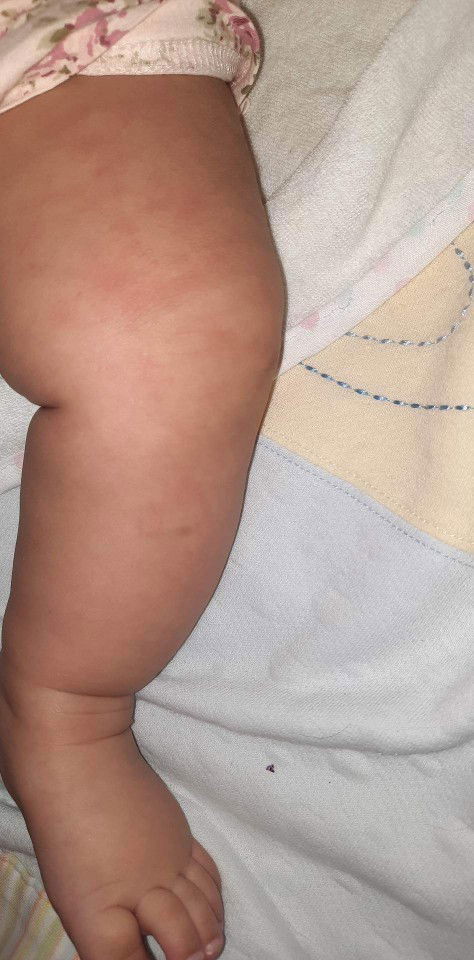 May pantal po sa legs ng baby ko