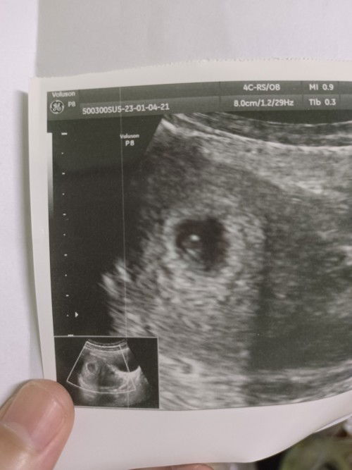 ตั้งครรภ์แรก