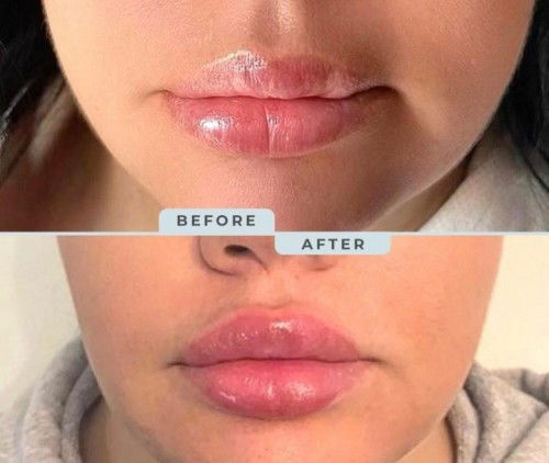 Dermal Fillers for Sale, botox injections(https://fillerderm.com/needles-cannulas/), microneedling d