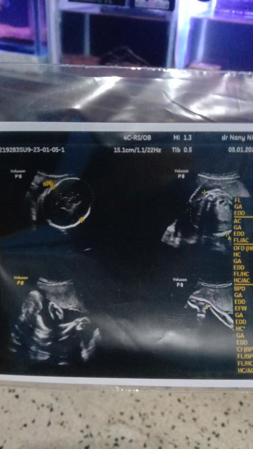 Mengatasi bayi melintang