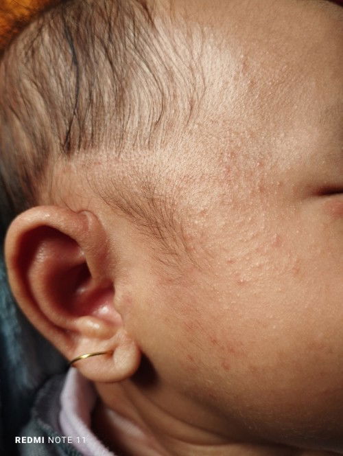 Bintik bintik Merah di Pipi dan Telinga