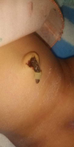 เกี่ยวกับสะดือลูกน้อย