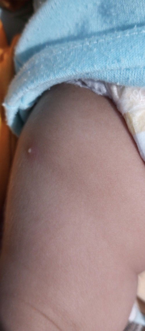 Imunisasi 2bln ada Nanah dan bengkak keras