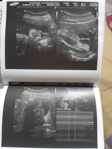 Pregnancy Breech Position