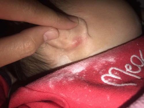 หลังหูลูกเริ่มเปื่อย
