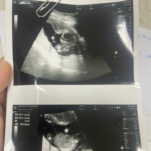 ใบอัลตราซาวด์