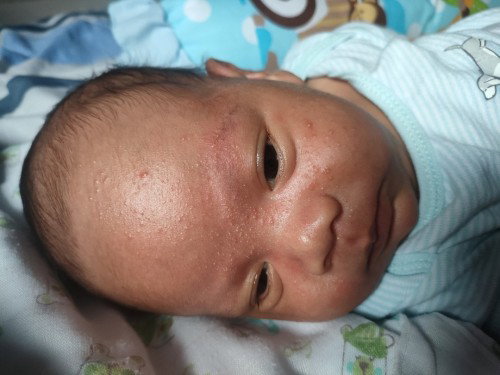 ผื่นเด็กแรกเกิด