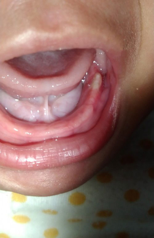 ini tumbuh gigi bukan ya?