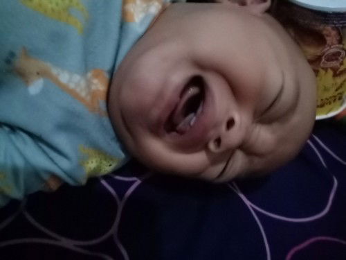 Lip tie pada anak umur 7 bulan