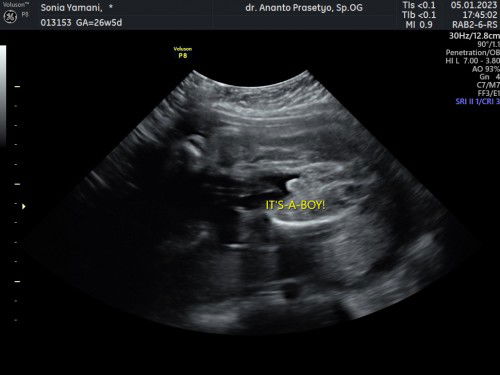USG 26minggu apakah jk nya sudah pasti benar