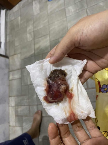 มูกเลือดแบบนี้ อันตรายไหมคะ