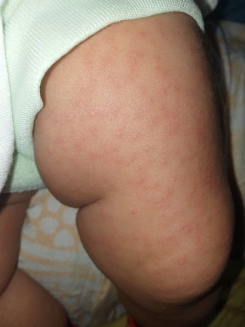 Campak pada bayi 4 bulan