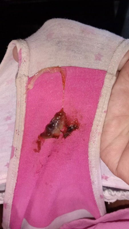 37W3D today. May lumabas na sa akin na parang buong dugo followed by parang slime na color white.