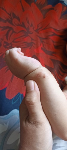 Scabies pada bayi