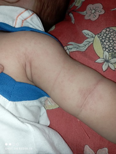 Rashes or what?