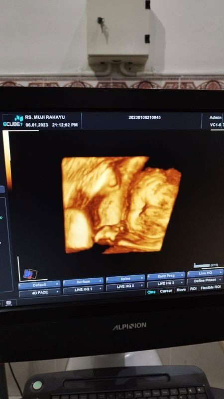 32minggu bb janin 2kg