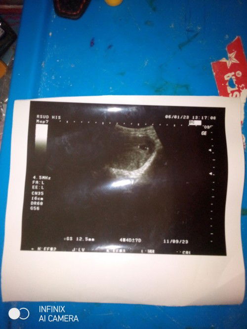 Hamil udah 10w, keluar flek dan agak lumayan klwr drh, tp bukn gumpalan