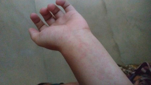 Alergi memerah seperti ruam2