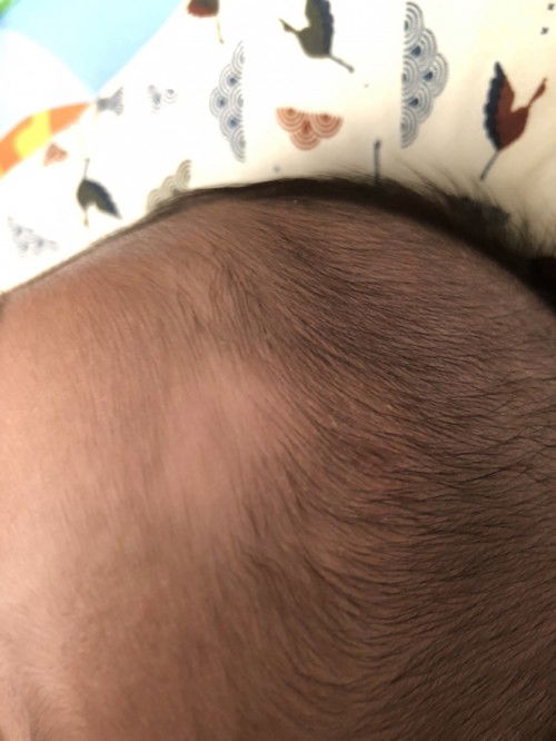 Bercak putih di kening bayi usia 2 bulan