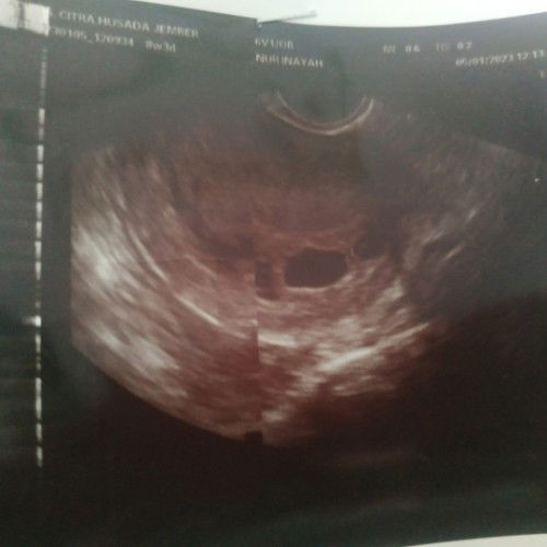 Hitungan hpht & USG beda 4 minggu