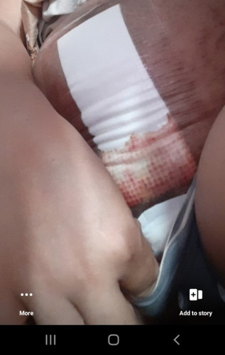 Bleeding after c section incision