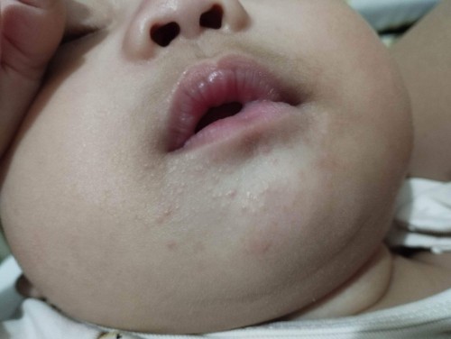 Hello mommies HFMD po ba ito? kamot po kasi ng kamot si baby meron narin sa mata nya kamay at paa