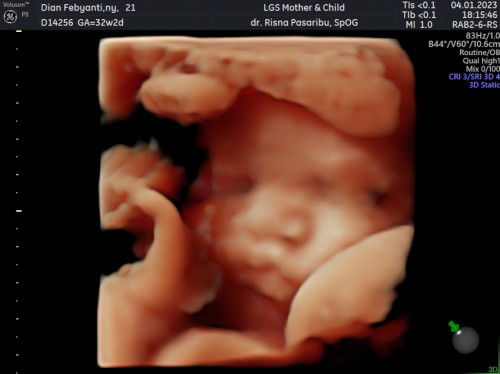 Bbj janin 32 minggu