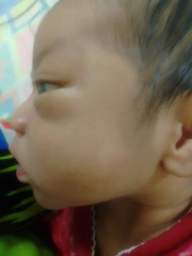 น้อง11วันมีฟผื่นขึ้นแบบนี้