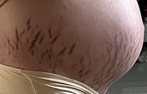 stretchmark parah