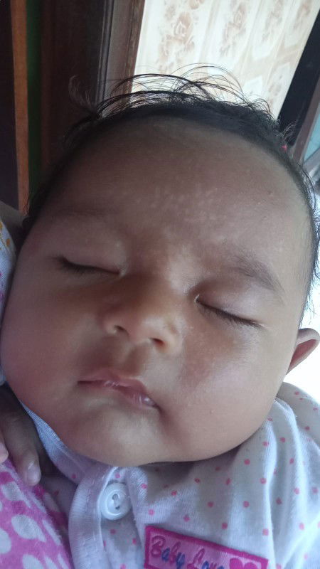 Cara menghilangkan bercak putih