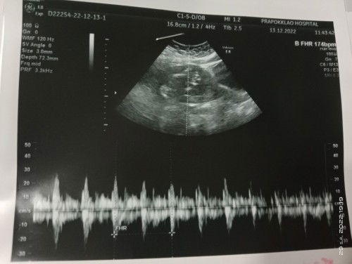 ผลการตรวจหาดาวน์ซินโดรม