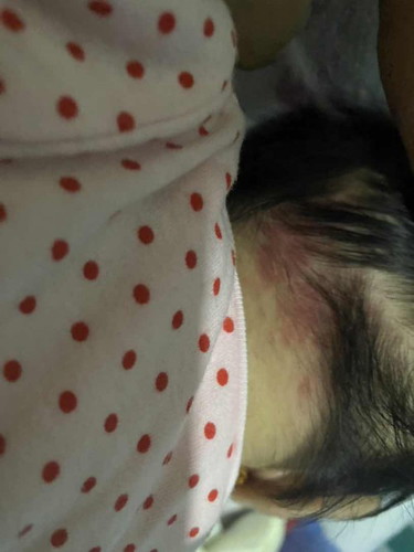 Red patches sa batok