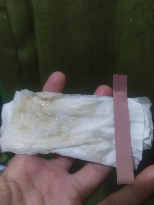 Bun tanya dong ini Keputihan apa ketuban ya kok anyir