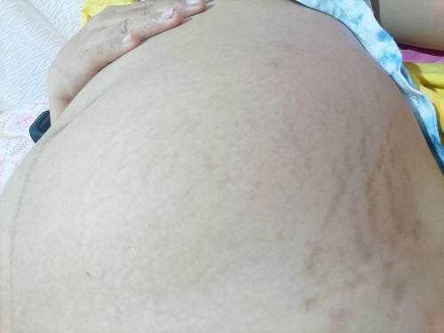 Stretchmark