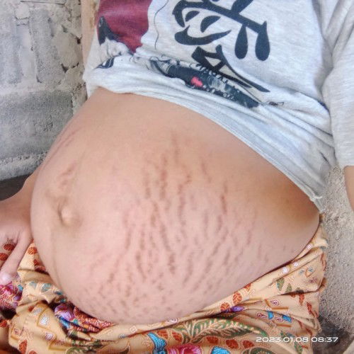 แม่บ้านไหนผ่าคลอดบ้างค่ะ